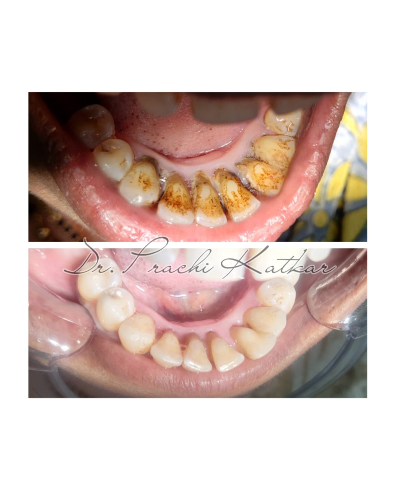 teeth cleaning treatment